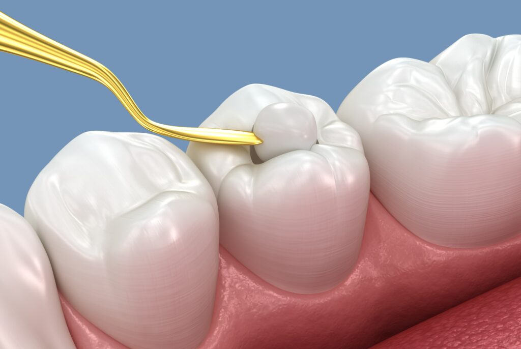 dental sealants ballwin